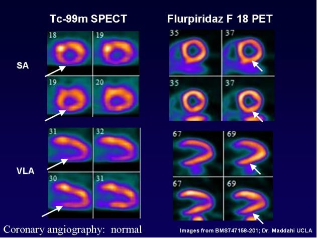 Novel PET Cardiac Imaging Agent Improves Detection of Coronary